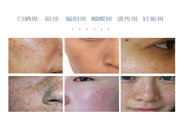 極致美白祛斑霜讓你擺脫“素顏煩惱”-歐泉生化 極致美白祛斑霜讓你擺脫“素顏煩惱”-歐泉生化