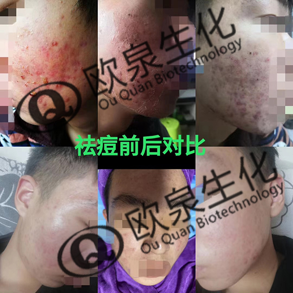 好產(chǎn)品不分距離—祛痘精華液-歐泉生化 好產(chǎn)品不分距離—祛痘精華液-歐泉生化