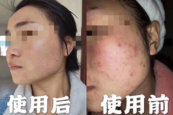 祛痘膏是真的有用嗎-歐泉生化 祛痘膏是真的有用嗎-歐泉生化